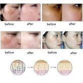 Before and after photos showing results of scars of acne treatment on different skin types with skin healing process illustrations