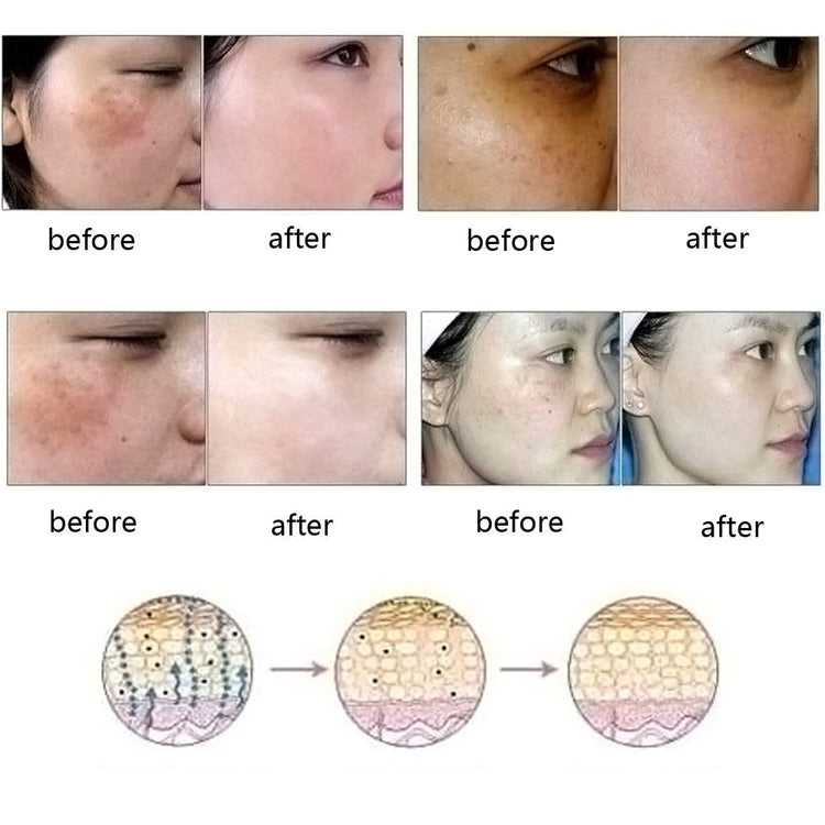 Before and after photos showing results of scars of acne treatment on different skin types with skin healing process illustrations
